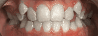 Braces/Invisalign Before and After Pictures in Atlanta, GA