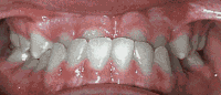 Braces/Invisalign Before and After Pictures in Atlanta, GA