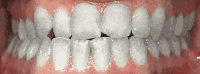 Braces/Invisalign Before and After Pictures in Atlanta, GA
