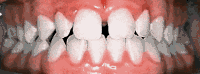 Braces/Invisalign Before and After Pictures in Atlanta, GA