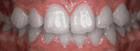 Braces/Invisalign Before and After Pictures in Atlanta, GA