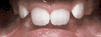 Braces/Invisalign Before and After Pictures in Atlanta, GA