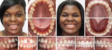 Invisalign Atlanta Teeth