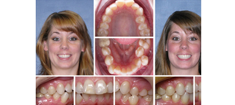 Invisalign Atlanta Teeth