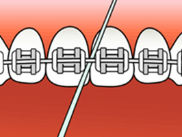 Step 2:  Carefully floss around the braces.