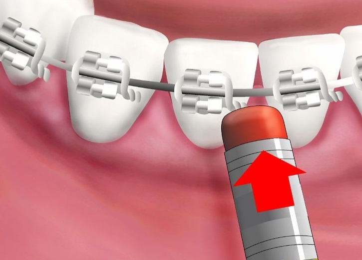 poking-wire - Georgia School of Orthodontics in Atlanta and Gwinnett