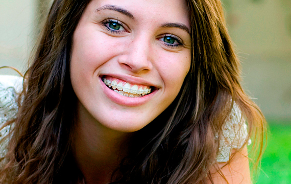 Ceramic Braces  Clear Orthodontic Options