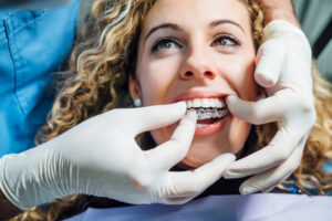 Doctor putting a clear dental aligner on a woman patient